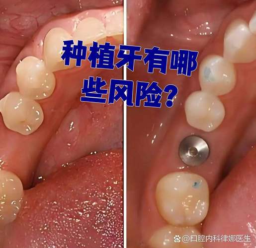 种植牙风险和后遗症_牙齿种植后遗症_全口种植牙有什么风险和后遗症