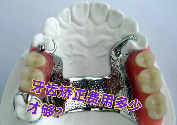 长沙矫正牙齿费用一览：从几千到几万差在哪