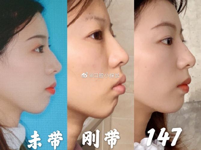 深圳公立医院正畸_深圳正畸比较好的医生_深圳公办医院正畸靠谱吗