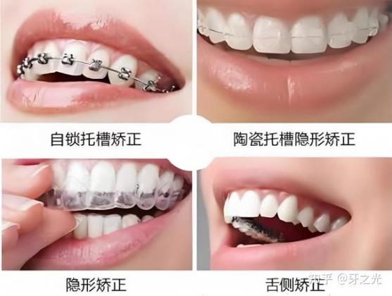 暴门牙矫正要多少钱_矫正门牙费用_矫正门牙需要多少钱