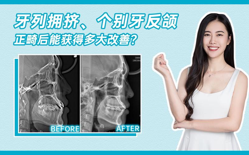 深圳市牙齿矫正_深圳医院牙齿矫正多少钱_深圳青少年牙齿拥挤矫正医院