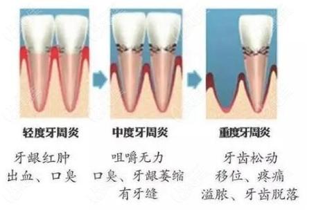 深圳牙周炎治疗到底要花多少钱？2026最新费用解析