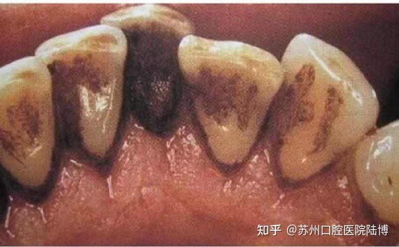 深圳牙周炎治疗费用_深圳牙周炎治疗可以医保报销吗_深圳看牙周炎哪个医院好
