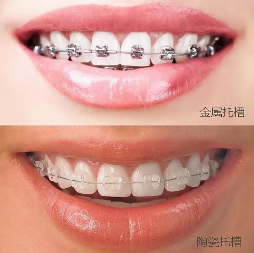 深圳深覆合矫正费用大揭秘：到底多少钱才靠谱？