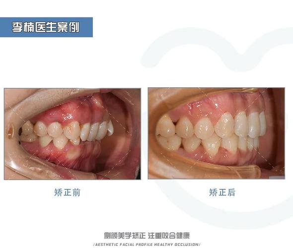 深圳深覆合牙齿矫正多少钱_牙齿矫正深覆合医生不管_牙齿深覆合矫正器