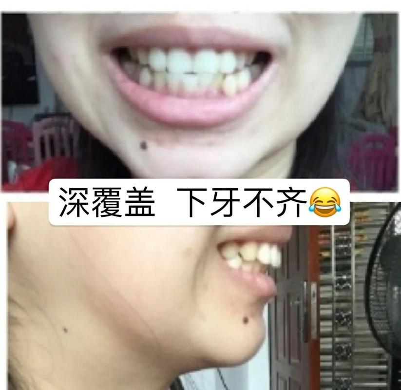 39岁牙齿矫正还有用吗 真实效果看这里