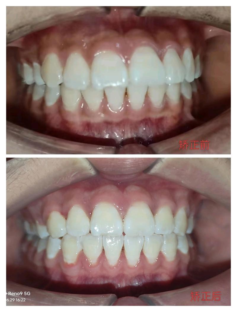 效果牙齿矫正有用吗_39岁牙齿矫正有效果吗_效果牙齿矫正有什么好处
