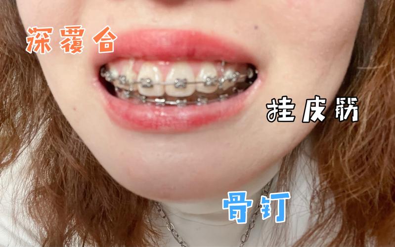 深圳深覆合正畸去哪家好？牙科推荐避坑指南