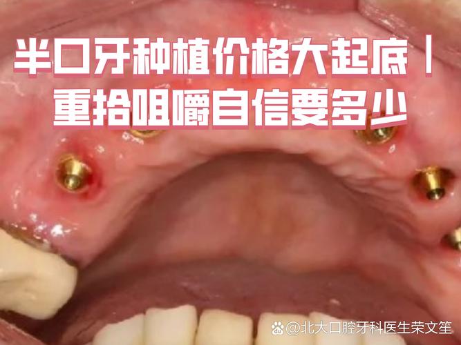 天津种植牙半口多少钱_天津种植牙的价格表_天津种牙多少钱